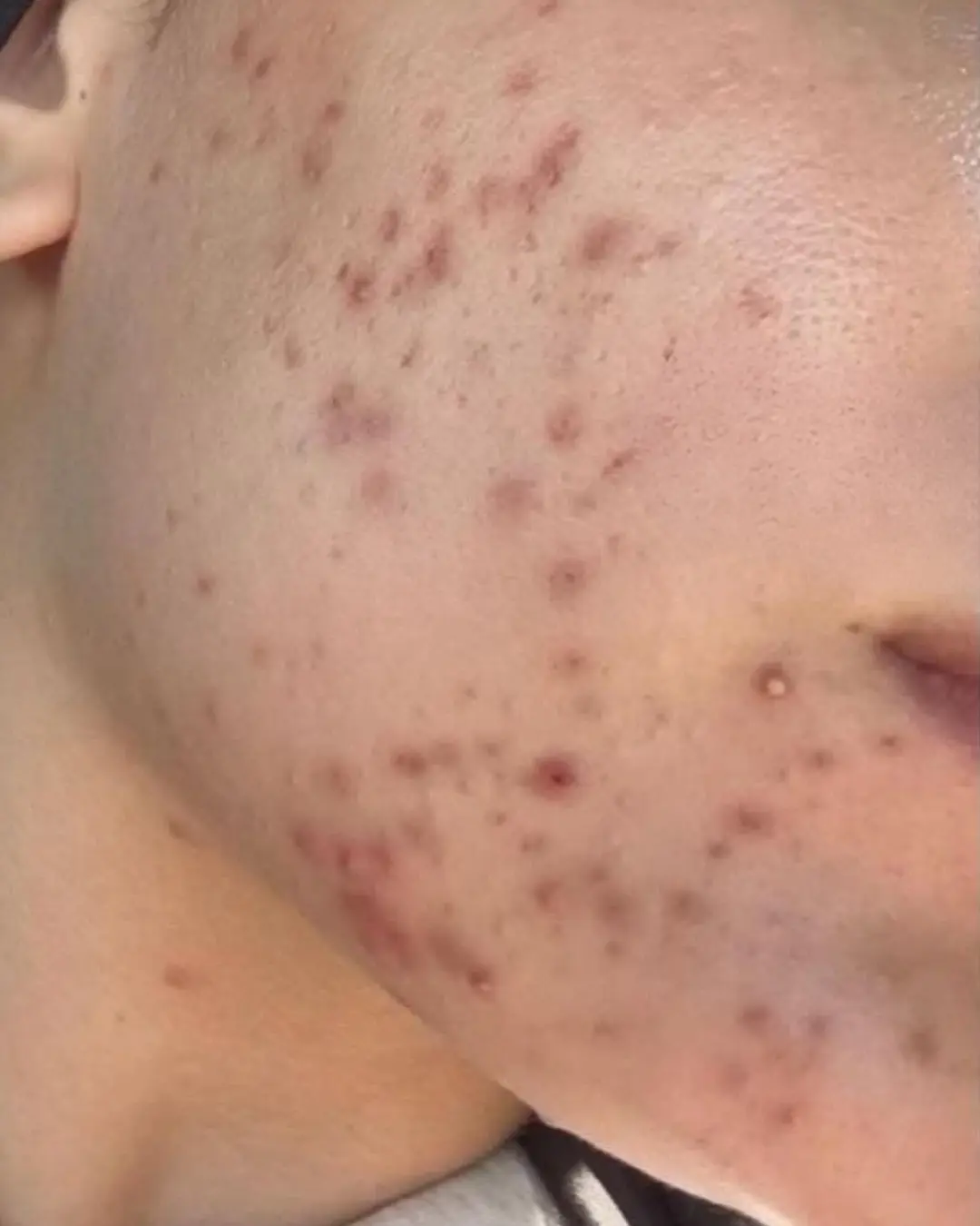 قبل علاج آثار حب الشباب