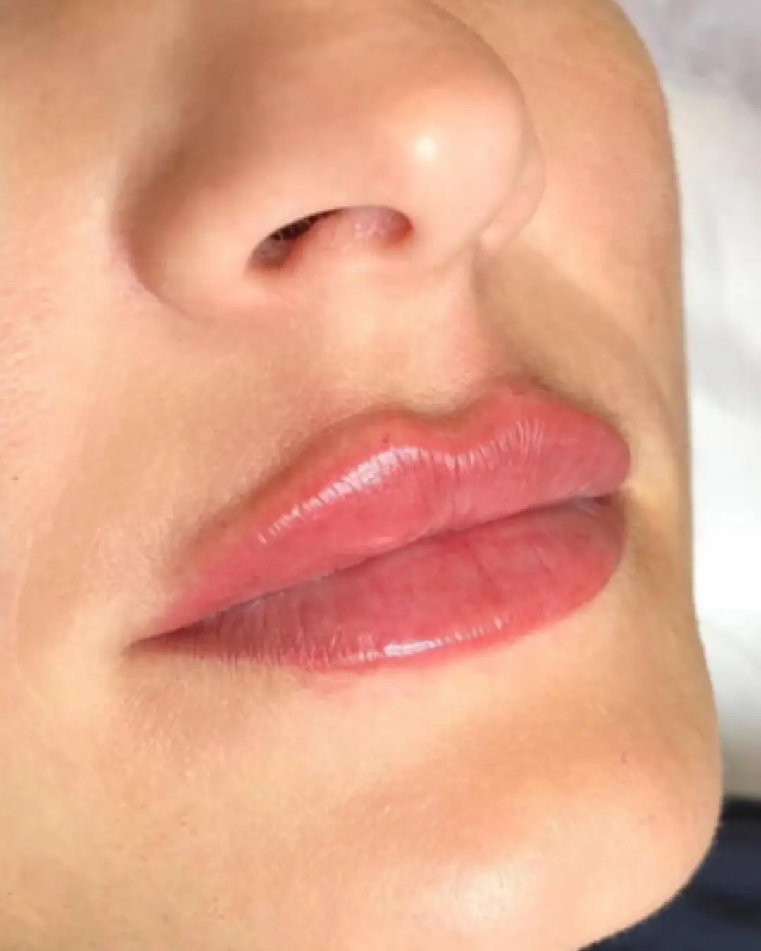 بعد فيلر الشفاه والخدود