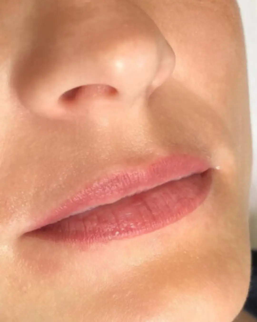 قبل فيلر الشفاه والخدود