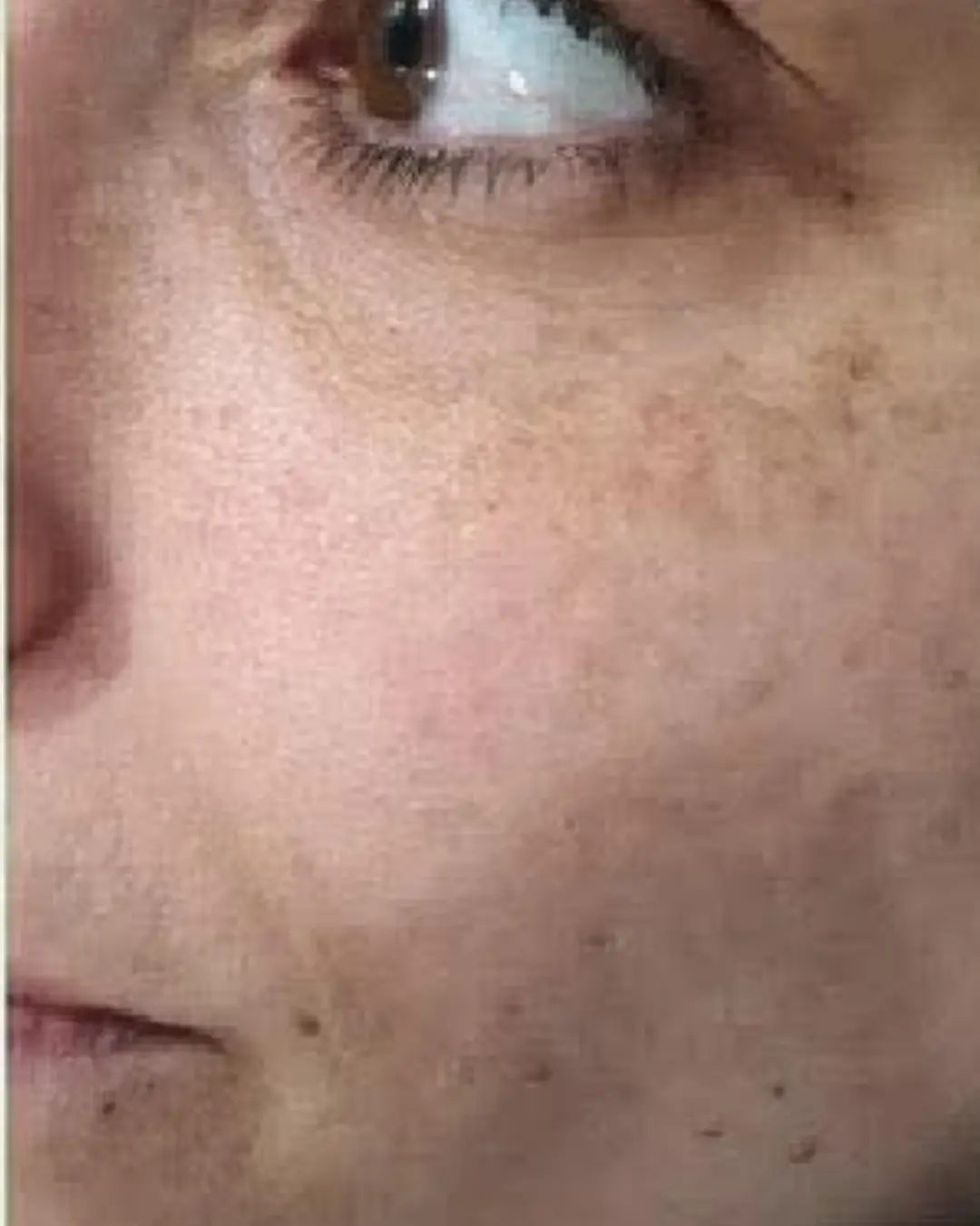 قبل إزالة التصبغات